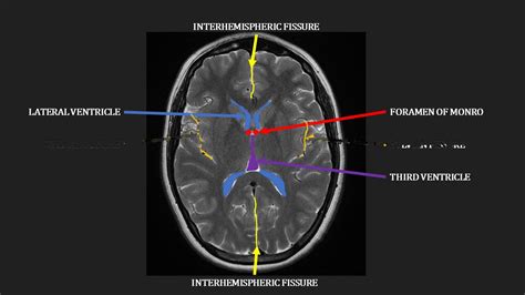 Introduction to MRI of the brain - YouTube