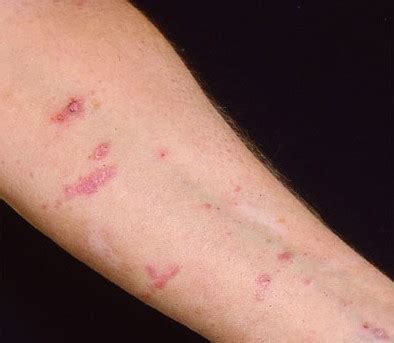 Rash Identification | Just-Health.net