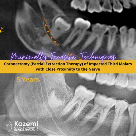 Coronectomy partial extraction therapy impacted wisdom tooth close to ...