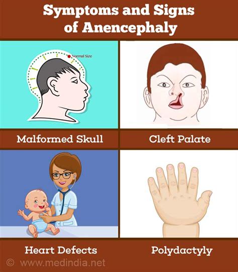 Anencephaly - Causes, Symptoms, Diagnosis and Treatment