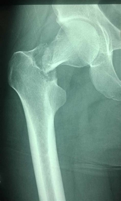 Femoral neck fracture x ray - foliowery