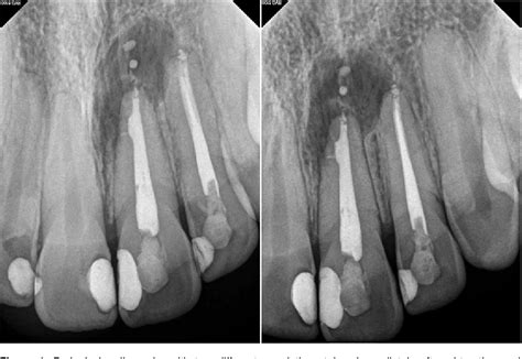 Figure 1 from Three-year follow-up: Healing of a large periapical ...