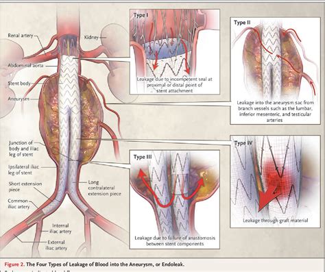 Figure 1 from Endovascular repair of abdominal aortic aneurysm ...