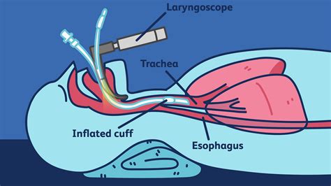 Surgery Intubation - Goddess Healthy