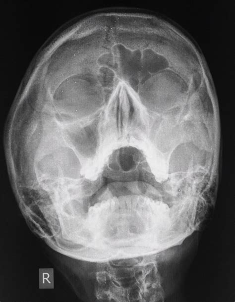 MAXILLARY SINUSITIS | Buyxraysonline