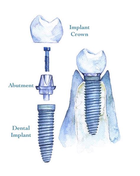 Dental Implants - Portland Perio Implant Center