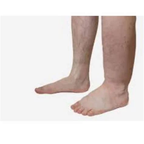 Elephantiasis Treatment Services at Rs 2500 in Noida | ID: 25989088430