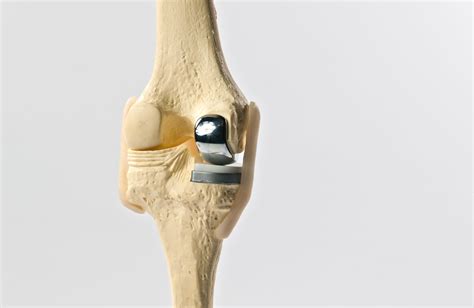 Partial Knee Arthroplasty | Dr. Michael Serhal