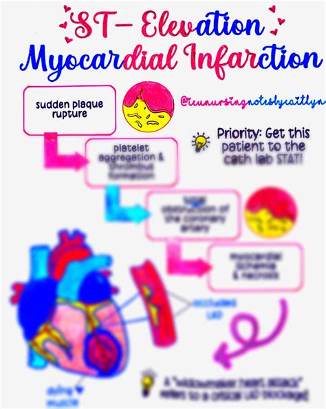 Pathophys of a STEMI - Etsy