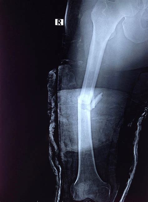 Fracture of the Femoral Shaft