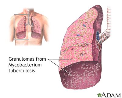 Disseminated tuberculosis Information | Mount Sinai - New York