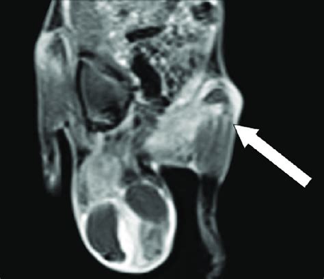 Contrast T1 MRI showing significant contrast enhancement MRI: Magnetic ...