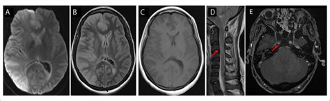 Patient 2 had right cerebral hemispheric restricted diffusion ...