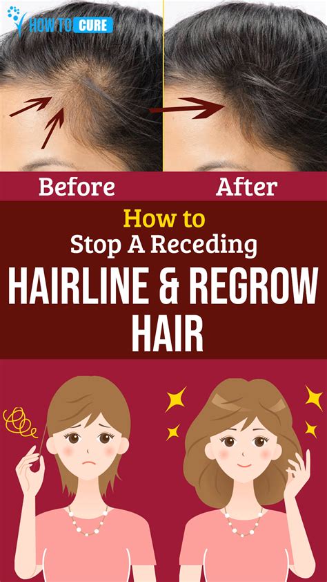 How To Stop A Receding Hairline – HowToCure- Are you looking to thicken ...