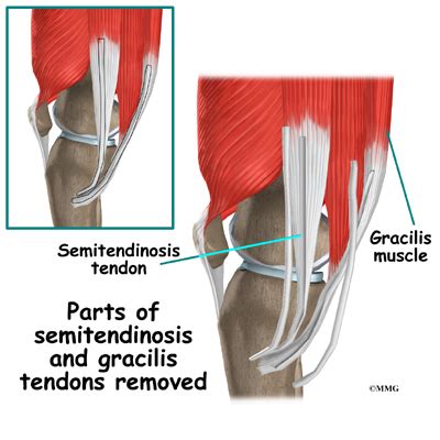 Hamstring Tendon Graft Reconstruction of the ACL - Orthogate