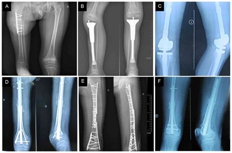 Osteosarcoma Symptoms