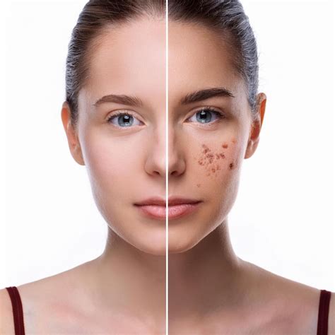 Split face closeup portrait of young woman before and after acne ...