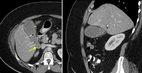 Acute cholecystitis on CT - Radiology at St. Vincent's University Hospital