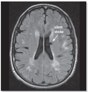 Stroke Brain Mri