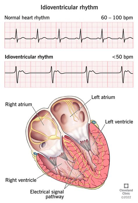 Accelerated Junctional Rhythm