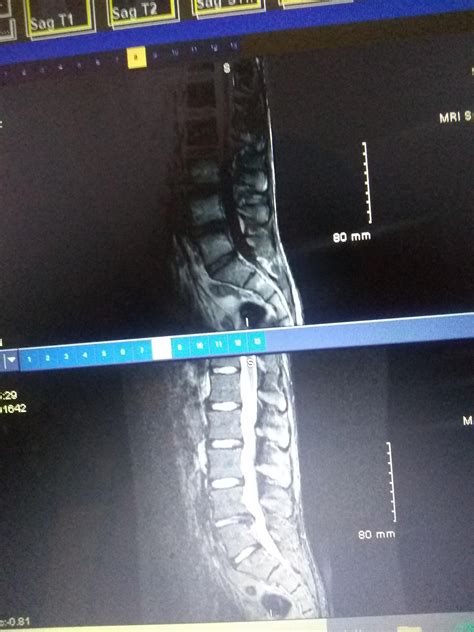 Mri results : r/Sciatica