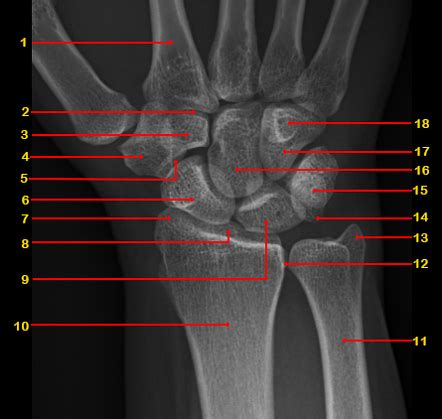 Wrist (PA view) | Radiology Reference Article | Radiopaedia.org