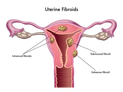 Uterine Fibroids – 10 Things You Should Know | Your IVF Journey