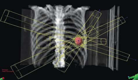 Radiation Therapy: Stereotactic Body Radiation Therapy