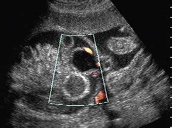 Cloacal Abnormalities | Radiology Key