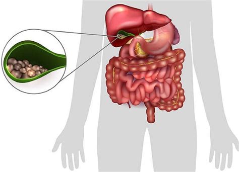 Choledocholithiasis: 10 Choledocholithiasis Symptoms