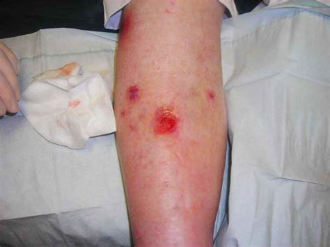 Atlanta Vascular & Vein Centers | Venous Ulcer Sores - How to Treat