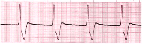 Accelerated Idioventricular Rhythm - EKG Lesson #315