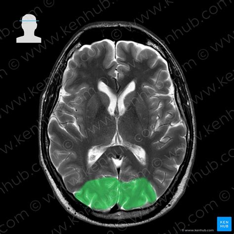 Normal brain MRI