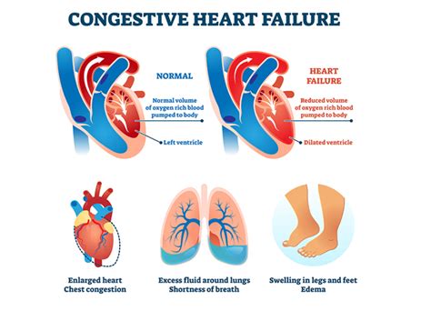 Diagnosing Congestive Heart Failure | Dr. Raghu Cardiologist