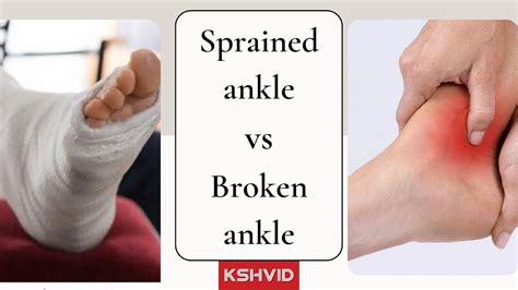 Sprained Ankle Vs Broken Ankle | Symptoms & Treatment : r/HEALTHY