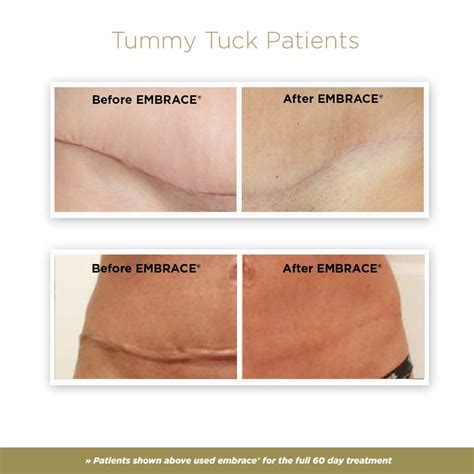 Embrace Active Scar Defense for New Tummy Tuck Scars, FDA-Cleared Extra ...