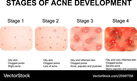 Stages development acne inflamed skin Royalty Free Vector