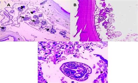 (A&B): Histopathology of hydatid cyst. A. Broad capsule containing ...