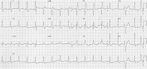 Pe ecg findings - wpolizX