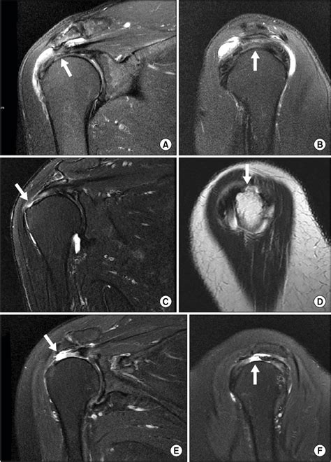 Supraspinatus Muscle Tear