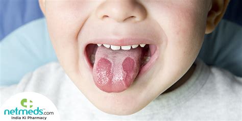 Geographic Tongue: Causes, Symptoms And Treatment