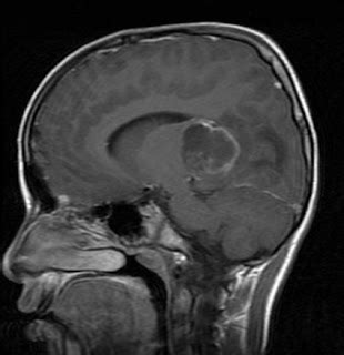 Pilocytic Astrocytoma- MRI Findings - Sumer's Radiology Blog