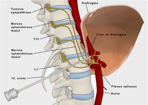 Celiac Plexus Block Doctor in New Delhi | Celiac Plexus Specialist ...