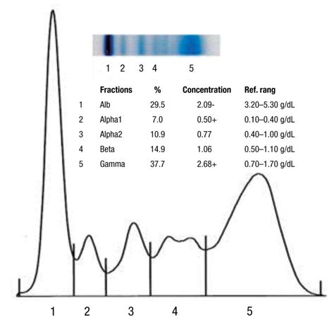 Electrophoresis Serum Protein Test Results