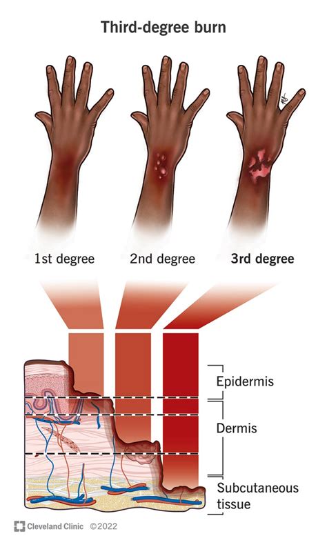 3rd-Degree Burn: What It Is, Treatment & Healing