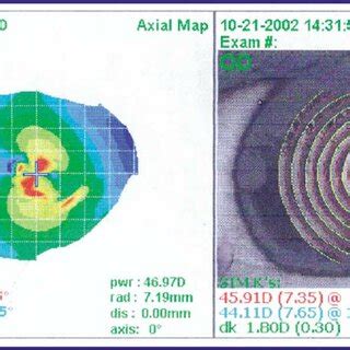 Anterior basement membrane dystrophy (ABMD) corneal topography before ...