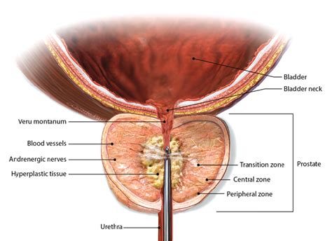 Treatments for Benign Prostatic Hyperplasia - Mass General Advances in ...