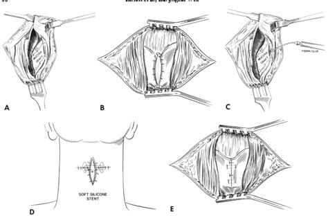 Figure 1 from Surgical Treatment of Laryngeal Web with Mucosa Graft ...