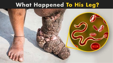 Elephantiasis - What Happen To Our body In Elephantiasis? (Urdu/Hindi ...