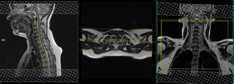 Brachial Plexus Anatomy Mri